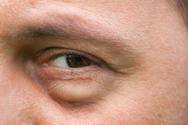 A szem alatti karikák komoly betegségeket jelezhetnek