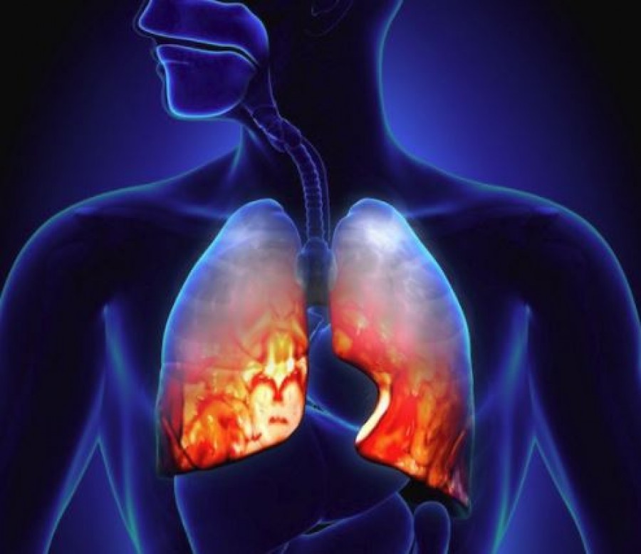 7 jel, amiből felismerhető a tüdőgyulladás